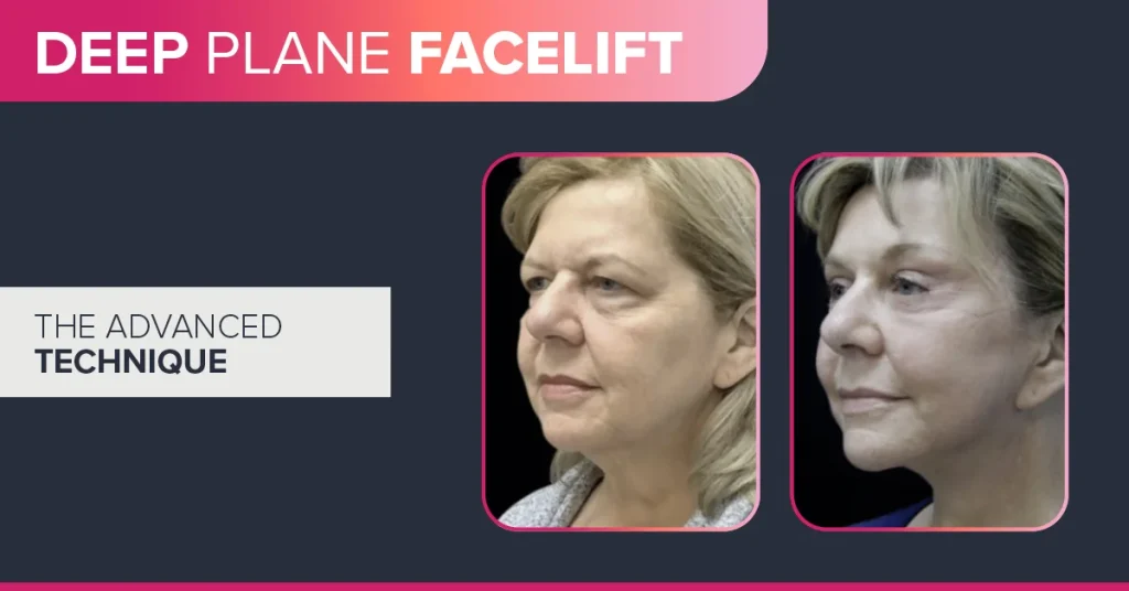 Deep Plane Facelift The Advanced Technique Behind Natural-Looking Results