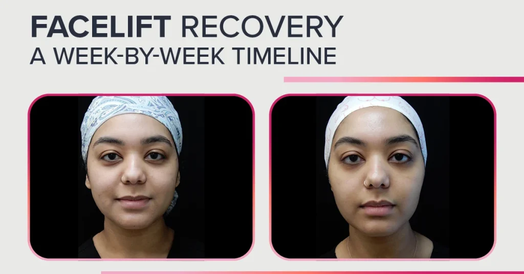 Your Facelift Recovery Timeline: What Really Happens Week by Week