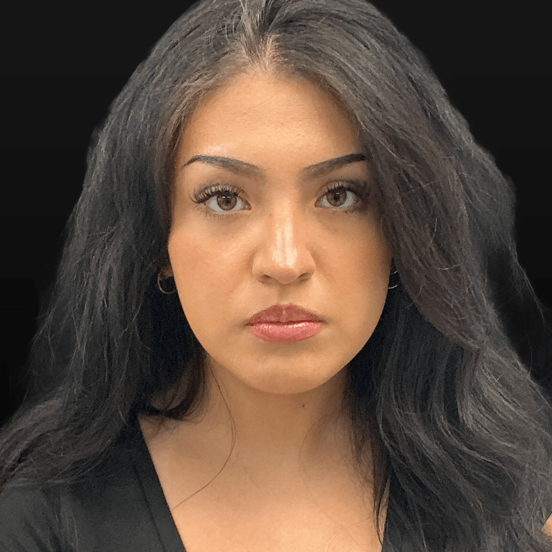 Rhinoplasty CSA