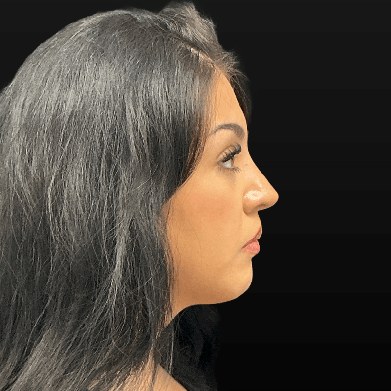Rhinoplasty CSA
