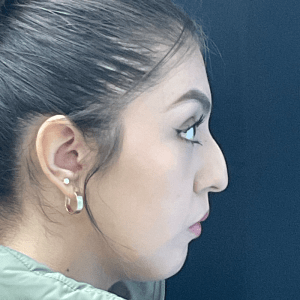 Rhinoplasty CSA