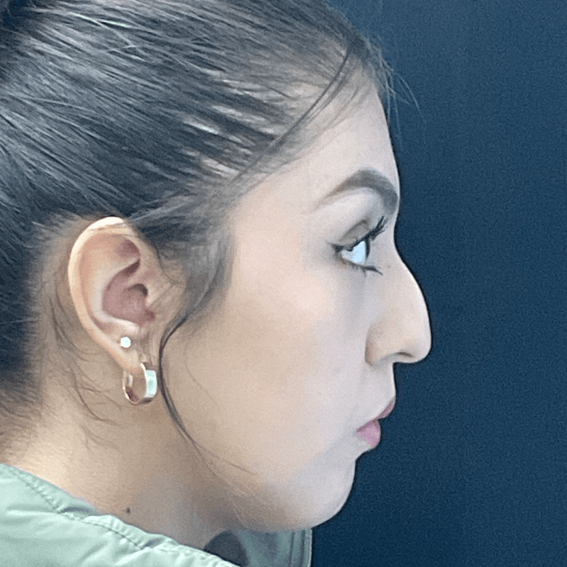 Rhinoplasty CSA