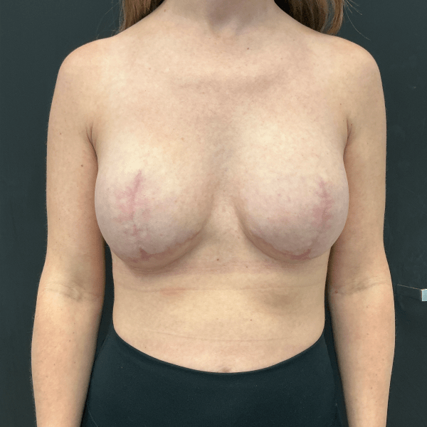 Mastectomy CSA