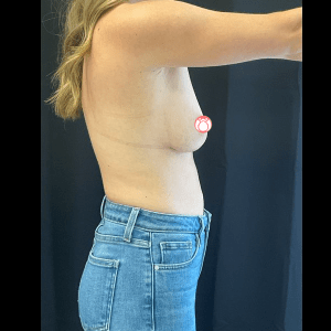 Mastectomy CSA