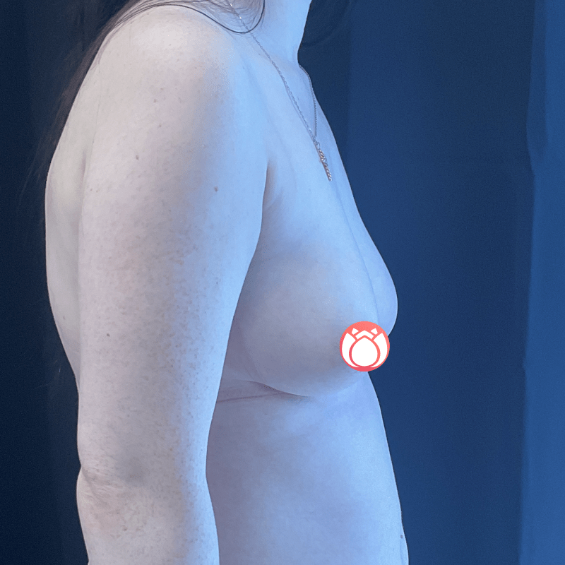 Breast Augmentation CSA
