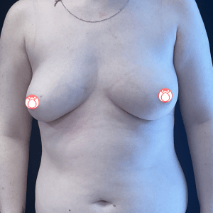 Breast Augmentation CSA
