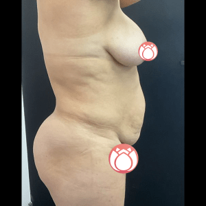 Tummy Tuck and Liposuction CSA