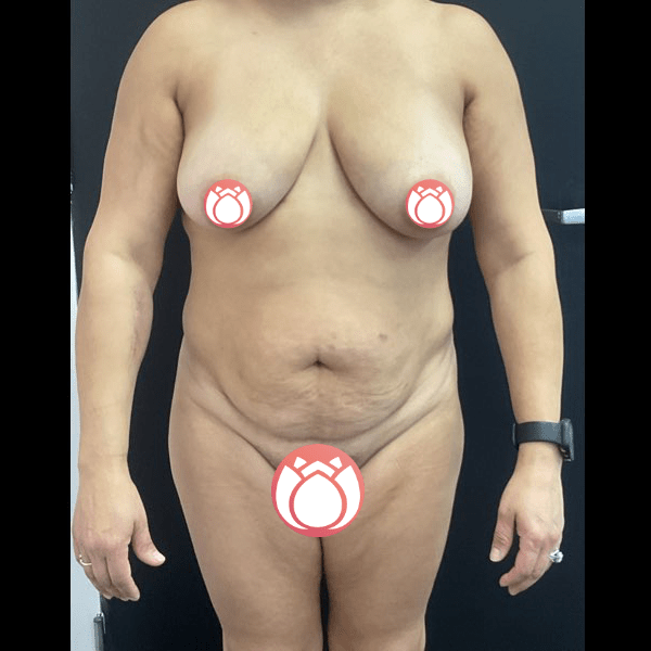 Tummy Tuck and Liposuction CSA