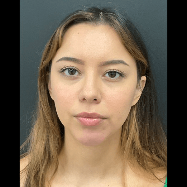 Neck lift with chin augmentation CSA