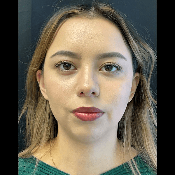 Neck lift with chin augmentation CSA