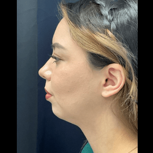 Neck lift with chin augmentation CSA