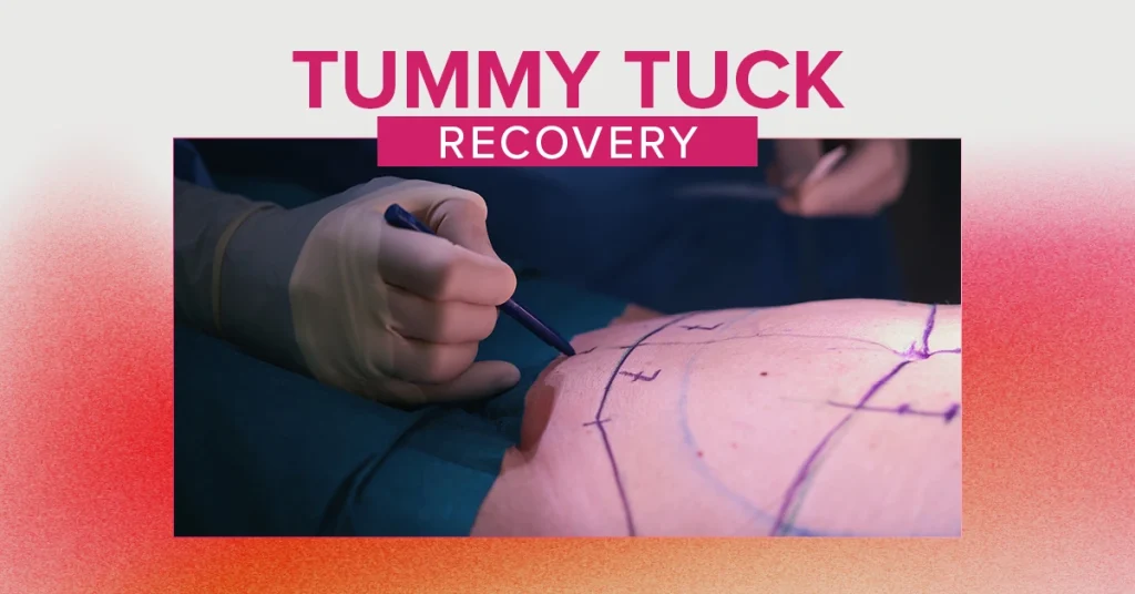 Surgeon marking a patient's abdomen before tummy tuck surgery, CSA