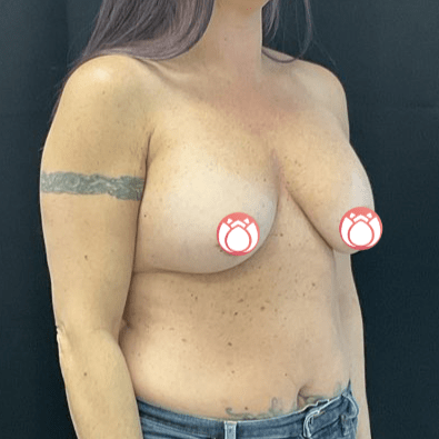 Breast Lift CSA