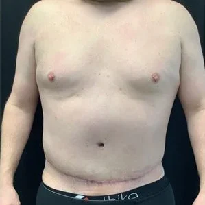 Excess Skin Removal in Jacksonville