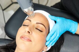 The Key to Eliminating Acne Scars